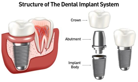 low cost dnetal implants 